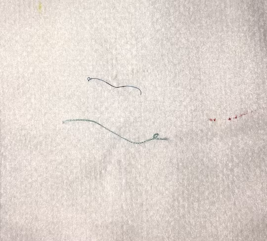 Mat mo, sung ne sau nhan mi, co gai hoang hon khi bac si lay ra vat nay-Hinh-2