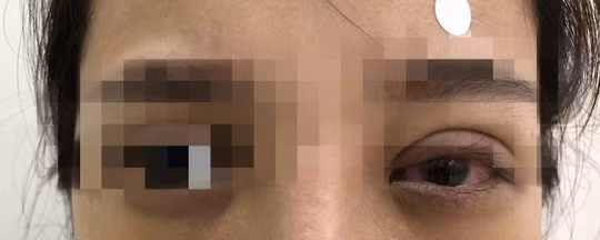 Mat mo, sung ne sau nhan mi, co gai hoang hon khi bac si lay ra vat nay