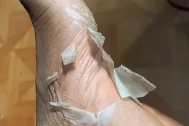 Nhiều người trên khắp thế giới đang đổ xô đi mua mặt nạ lột da chân - loại mặt nạ dành riêng cho bàn chân. Sau khi sử dụng loại mặt nạ này trong tối đa 90 phút để thành phần nước trái cây trong mặt nạ phát huy tác dụng thì người dùng bắt đầu lột da chân.