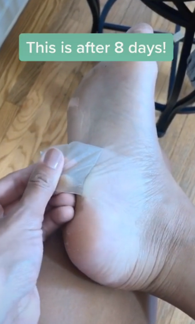 Hiện tại đã có hàng nghìn video trên Tik Tok chia sẻ cảnh tượng lột da chân, khiến cư dân mạng vừa thấy kinh hoàng, vừa tò mò một cách kỳ lạ.