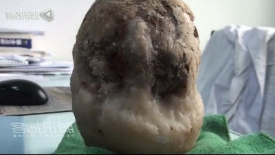 Viên sỏi khổng lồ.