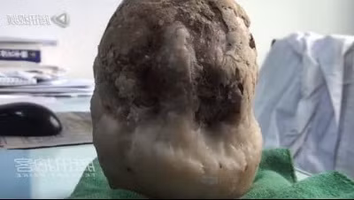 Viên sỏi khổng lồ. Viên sỏi khổng lồ.