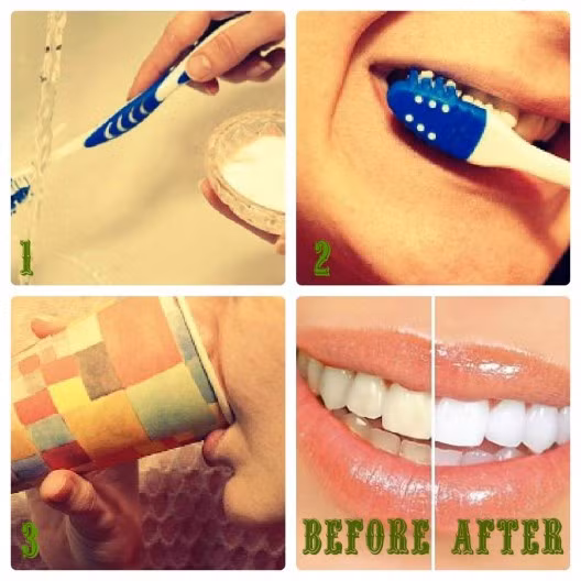 Thực tế, việc làm đó đôi khi gây họa nghiêm trọng. Bạn có thể bị bỏng nướu răng, gãy cổ chân răng, viêm tủy răng do sử dụng hóa chất tẩy trắng răng không rõ nguồn gốc, tẩy trắng răng không đúng cách.