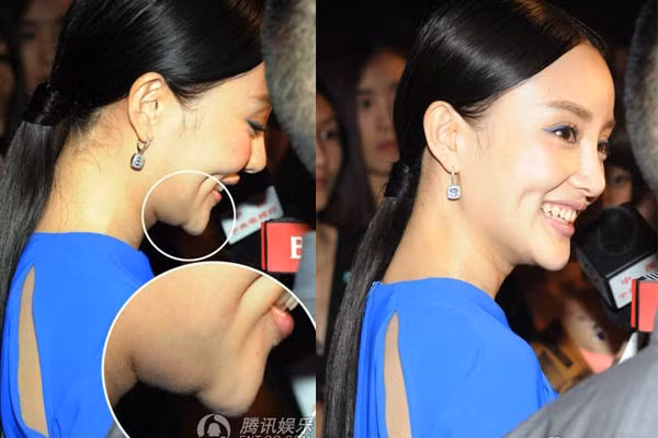 Có thể nói, trước đây, Lý Tiểu Lộ sở hữu gương mặt không hề tầm thường. Những đường nét thanh tú, trong sáng luôn giúp cô chiếm được cảm tình của khán giả qua những vai diễn chính diện ngọt ngào. Chính vì vậy, hình ảnh gần đây với chiếc cằm nhô xấu xí và lệch lạc của người đẹp lại khiến nhiều người không khỏi tiếc nuối cho nhan sắc 1 thời.