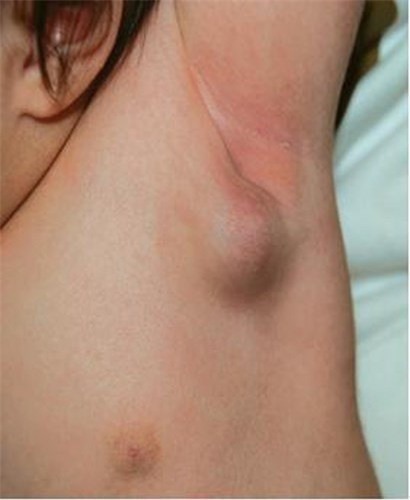 Số lượng hạch cũng có thể là dấu hiệu cảnh báo bệnh ung thư nguy hiểm.