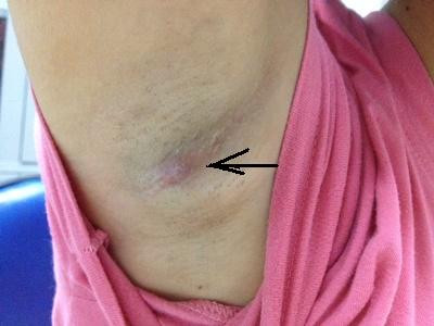 Tình trạng hạch mềm hay cứng cũng cảnh báo nguy cơ bệnh tật của bạn. Để biết hạch bất thường hay không hãy dùng tay sờ nắn trược tiếp vào hạch đó.