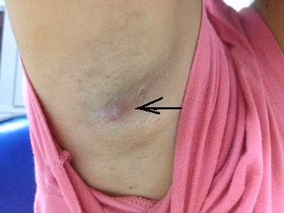 Tình trạng hạch mềm hay cứng cũng cảnh báo nguy cơ bệnh tật của bạn. Để biết hạch bất thường hay không hãy dùng tay sờ nắn trược tiếp vào hạch đó.