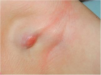 Theo thống kê những người dưới 30 thì khoảng 79% hạch nổi là lành tính, khoảng 15% hạch nổi do tăng sinh không kiểm soát các tế bào lympho, và khoảng 6% là bị bệnh ung thư.