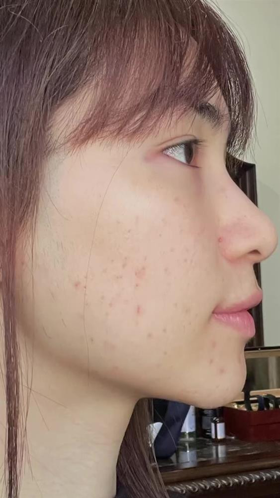 Sau khi các vết mụn bong vẩy, cần thoa các thuốc trị thâm, sau đó tiếp tục đắp mặt nạ dưỡng da, cung cấp độ ẩm, mịn màng cho làn da.