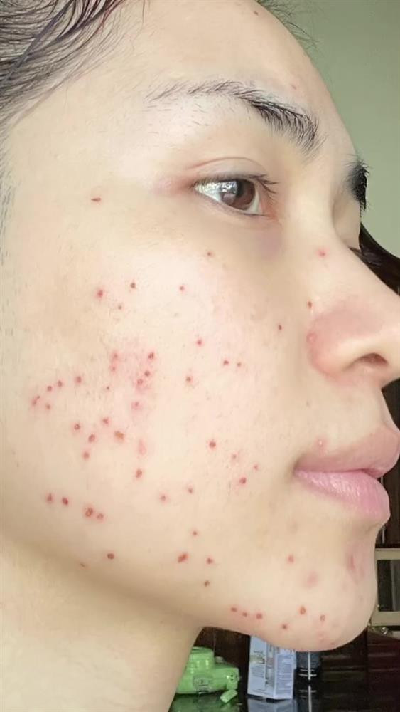 Để làm sạch chỉ nên dùng sữa rửa mặt lành tính hoặc nước muối sinh lý, tuyệt đối không nên bôi trét những thứ khác.