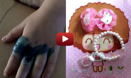 Tay bé gái bị nhiễm trùng nặng vì đeo nhẫn đồ chơi.