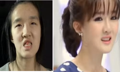 Hình ảnh người phụ nữ trước và sau phẫu thuật thẩm mỹ.