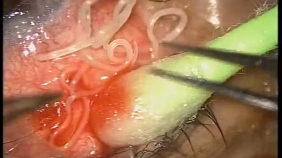 Hình ảnh con giun dài 20cm ký sinh trong mắt người.