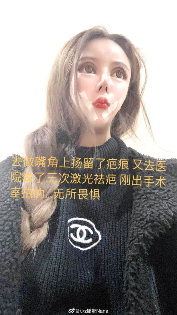 Nana liệt kê, cô đã trải qua 6 lần phẫu thuật tạo mắt hai mí, 5 lần phẫu thuật cắt mí mắt (góc mắt ngoài), 3 lần hút mỡ toàn thân, 1 lần phẫu thuật gọt xương cả mặt, 2 lần hút mỡ mặt, 2 hút mỡ đùi và 3 lần phẫu thuật miệng,...