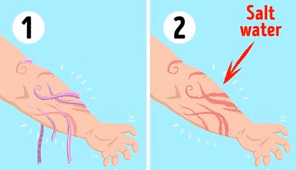 khi không may bị sứa "tấn công", bạn hãy làm sạch vết thương và loại bỏ phần còn lại của xúc tu sứa, rửa sạch vết thương bằng nước muối. Để loại bỏ độc tố, bạn hãy dùng giấm táo, hoặc rượu bôi lên vết thương rồi tới gặp bác sĩ để được tư vấn, trợ giúp.