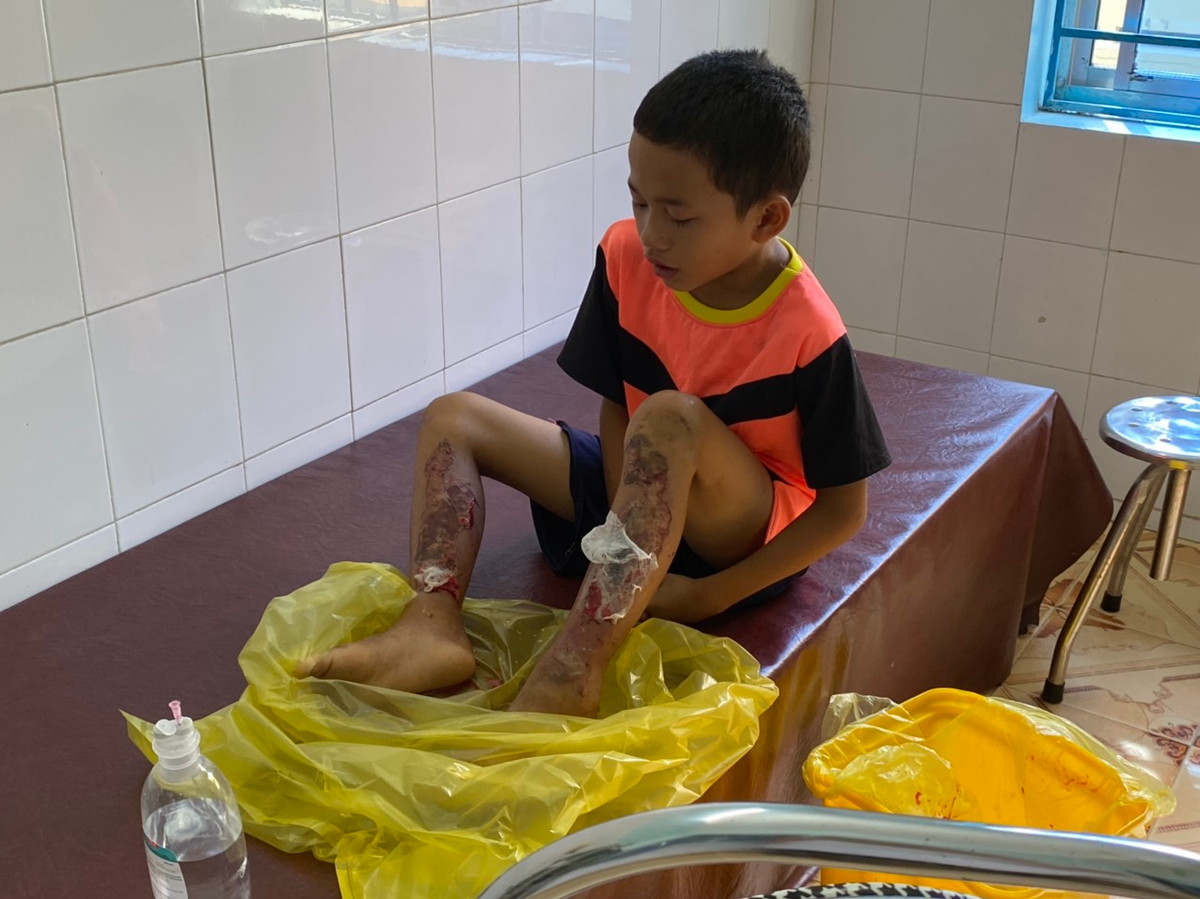 Tiếng khóc xé lòng của cháu bé bị bố tẩm xăng đốt chân Tieng khoc xe long cua chau be bi bo tam xang dot chan