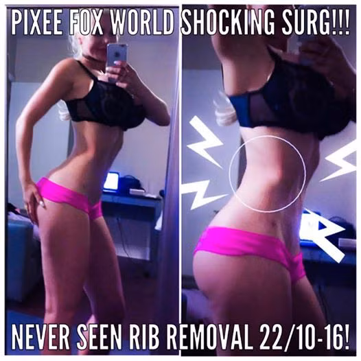 Đến nay, cô người mẫu 9x đã phẫu thuật đến 15 lần, gồm nâng ngực, hút mỡ, nâng mông, …Ca gần đây nhất là rút 6 cái xương sườn để có được vòng eo nhỏ xíu.