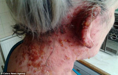 Bà đi khám bác sĩ và được cho thuốc kháng sinh và kem đặc trị, nhưng những vết dị ứng dường như càng tồi tệ hơn. Phải mất 8 tuần sau đó, làn da của người phụ nữ này mới hồi phụ hoàn toàn khi được điều trị đặc biệt bởi bác sỹ riêng.