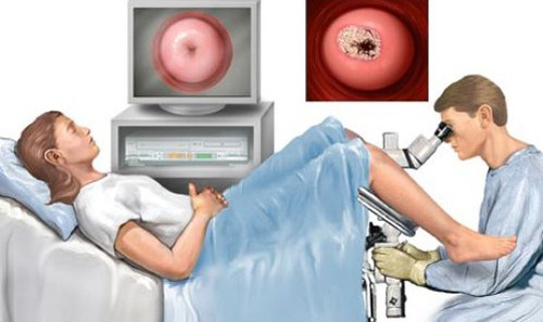 Sàng lọc ung thư cổ tử cung. Xét nghiệm ung thư cổ tử cung nên được bắt đầu ở tuổi 20 và phải được thực hiện 3 năm 1 lần. Căn bệnh này bắt nguồn từ virus HPV, (nhiễm trùng đường sinh dục), ảnh hưởng đến 75-80% phụ nữ và đàn ông.