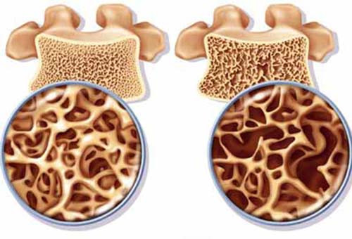 Hệ thống xương khớp. Hầu hết mọi người, đặc biệt phụ nữ sẽ bị loãng xương khi hóa trị, do thuốc gây giảm canxi. Với những người ung thư vú thì sự kết hợp của thuốc cộng với giảm nồng độ estrogen càng làm tăng nguy cơ gãy xương.
