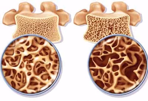 Hệ thống xương khớp. Hầu hết mọi người, đặc biệt phụ nữ sẽ bị loãng xương khi hóa trị, do thuốc gây giảm canxi. Với những người ung thư vú thì sự kết hợp của thuốc cộng với giảm nồng độ estrogen càng làm tăng nguy cơ gãy xương.