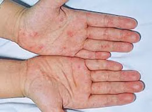 Triệu chứng khác nữa là xuất hiện ban đỏ trên da giống như bỏng nắng, bao gồm cả ở lòng bàn tay và lòng bàn chân, mắt đỏ do xung huyết kết mạc, có những vết đỏ bất thường ở mí mắt hoặc trong niêm mạc miệng...