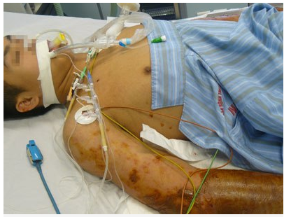 Tại Việt Nam, hồi tháng 5 vừa qua, bệnh viện Nhiệt đới Trung ương tiếp nhận một bệnh nhân 40 tuổi ở Thái Bình, trong tình trạng sốc nặng, viêm hoại tử toàn bộ da cánh tay bên trái. Nguyên nhân được xác định là do nhiễm vi khuẩn “ăn thịt người” Aeromonas hydropila. 