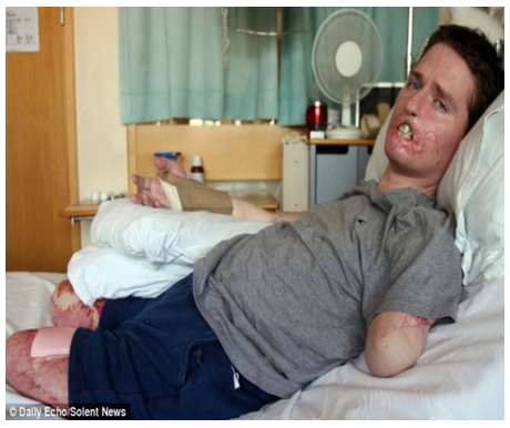 Alex Lewis, 34 tuổi sống tại thị trấn Stockbridge, Anh Quốc đã phải cắt bỏ cả 2 chân và cánh tay trái do loại vi khuẩn chết người. Tháng 11/2013, anh bị cảm cúm và được các bác sĩ chẩn đoán bị nhiễm trùng máu bởi vi khuẩn liên cầu nhóm A. Các cơ quan nội tạng chính của Alex cũng bị tổn thương khiến anh rơi vào tình trạng sống thực vật trong 1 tuần.