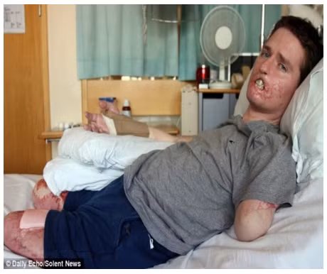 Alex Lewis, 34 tuổi sống tại thị trấn Stockbridge, Anh Quốc đã phải cắt bỏ cả 2 chân và cánh tay trái do loại vi khuẩn chết người. Tháng 11/2013, anh bị cảm cúm và được các bác sĩ chẩn đoán bị nhiễm trùng máu bởi vi khuẩn liên cầu nhóm A. Các cơ quan nội tạng chính của Alex cũng bị tổn thương khiến anh rơi vào tình trạng sống thực vật trong 1 tuần.