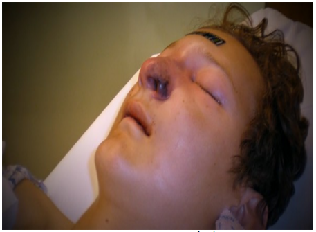 Năm 2009, Matthew McKinney (Mỹ), khi đó mới 14 tuổi buộc phải cắt bỏ nửa mũi trái, một phần vòm miệng và nhổ 5 chiếc răng khi bị vi khuẩn tấn công. Các bác sĩ chẩn đoán Matthew bị một loại vi khuẩn ăn thịt người tấn công qua đường mũi khiến cho vòm miệng bị phá hủy, các mô trong miệng trở nên thối rữa. Nhiễm khuẩn lan rộng tới phổi và xoang mũi khiến cho mũi cậu cũng bị hoại tử.