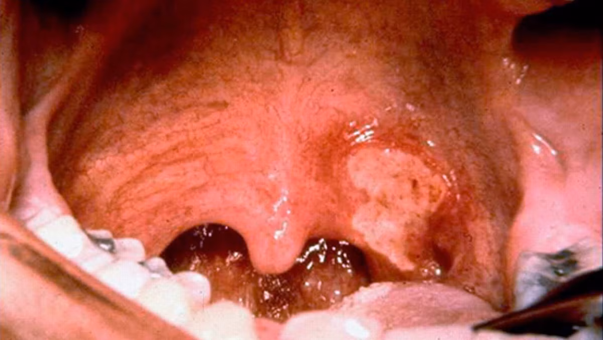 Những con số kinh hoàng về dịch bệnh bạch hầu Nhung con so kinh hoang ve dich benh bach hau