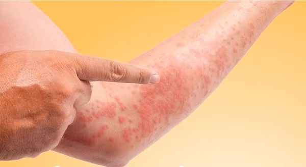 Phát ban: Bạn bị phát ban có thể là do cơ thể bạn bị viêm nhiễm do độc tố có trong thực phẩm.