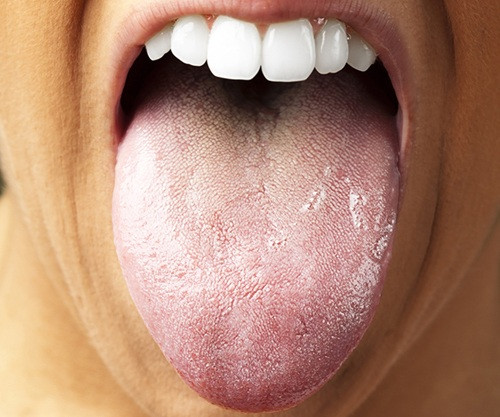 Lưỡi có mảng bám trắng: Bình thường, lưỡi của chúng ta có màu đỏ nhạt hoặc hồng sáng. Khi cơ thể nhiễm độc, bề mặt lưỡi xuất hiện các mảng bám trắng, vàng, hơi thở có mùi khó chịu. Lúc này bạn cần thanh lọc cơ thể ngay.