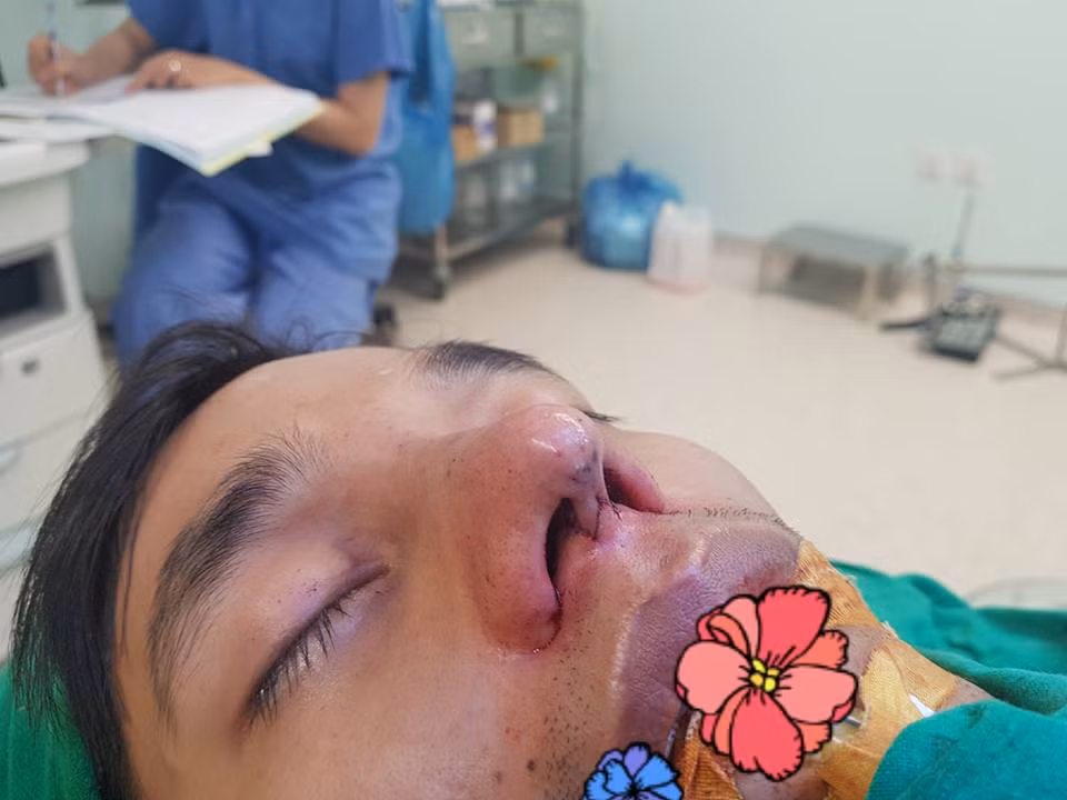 Chiều 25/7, những hình ảnh đầu tiên sau khi Lệ Rơi phẫu thuật thẩm mỹ, tháo băng ở mũi đã được lan truyền rộng rãi trên mạng xã hội. Sau ca phẫu thuật, dường như "ca sĩ Lệ Rơi" cũng phải chịu không ít đau đớn. Chàng trai Hải Dương hiện vẫn giữ im lặng, không hề chia sẻ bất cứ thông tin nào xoay quanh quyết định "tân trang nhan sắc" của mình và càng khiến dân mạng tò mò hơn nữa.