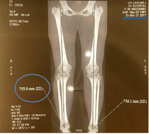 Kết quả X-quang xác định chiều dài đôi chân của Vũ Lâm tăng thêm 5cm.