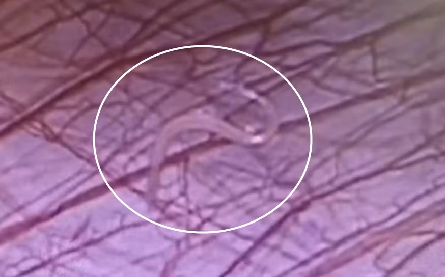 Bé gái đau bụng không lý do, phát hiện “quái thú” ký sinh Be gai dau bung khong ly do, phat hien “quai thu” ky sinh