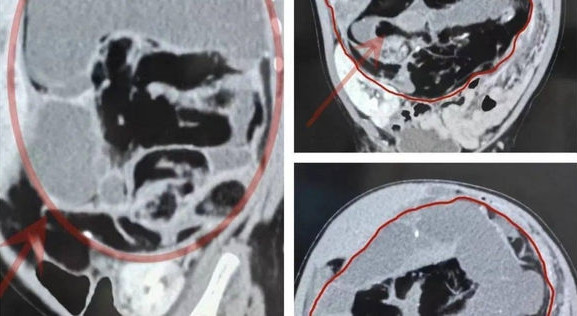 Be 8 thang tuoi bung to bat thuong, phat hien dieu kinh di