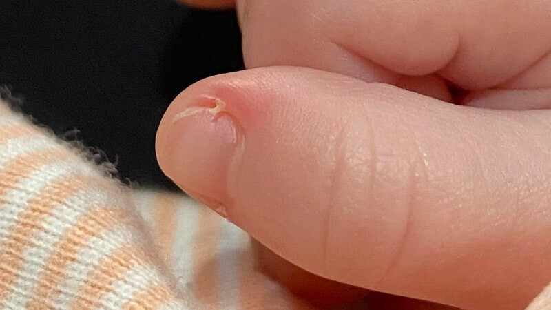 Cat xuoc mang ro, be trai suy tim phoi suyt chet