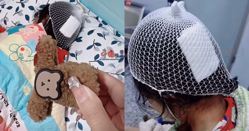 Dùng kẹp tóc càng cua, bé gái phải khâu 3 mũi trên đầu vì... Dung kep toc cang cua, be gai phai khau 3 mui tren dau vi...