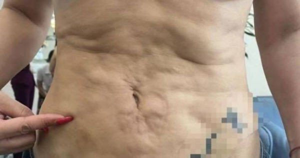 Di hut mo bung, vo gap hoa con bi chong doi ly hon