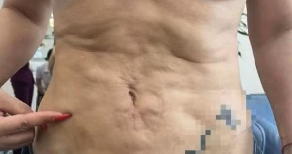 Di hut mo bung, vo gap hoa con bi chong doi ly hon