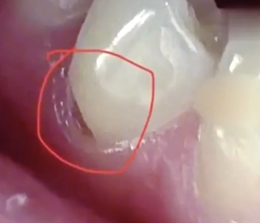 Chai rang theo chieu ngang, bac si lac dau khong cuu duoc