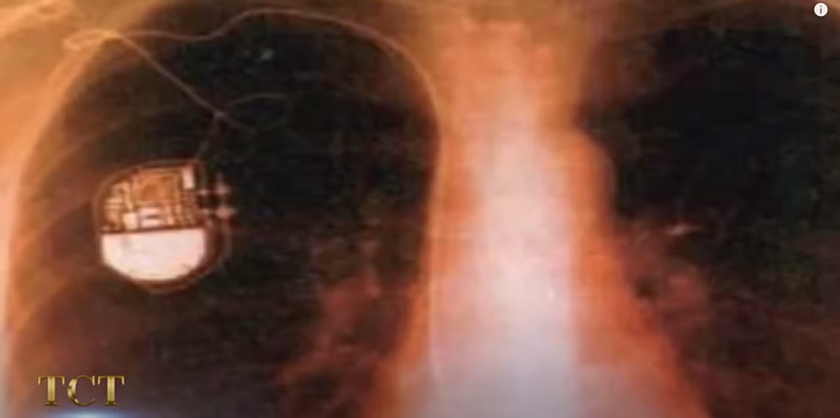 Sau khi phân tích kỹ lưỡng, các chuyên gia phát hiện ra ở vị trí trái tim xác ướp 2.500 tuổi này đã lắp một thứ giống như máy điều hòa nhịp tim. (Ảnh: TCT)