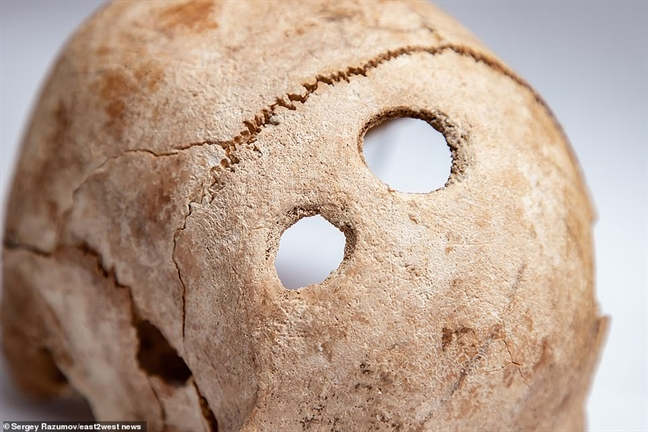 May mắn thay, phương pháp chữa trị này đã bị cấm hoàn toàn vào cuối thời Trung Cổ. Một số nghiên cứu trên các bộ sọ còn sót lại cho thấy, vài bệnh nhân vẫn có thể sống sót sau phương pháp điều trị cực đoan này.