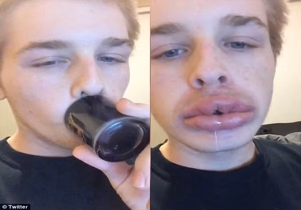 Rất nhiều trường hợp đạt đến độ sưng to và có cả những vết bầm tím xung quanh miệng.