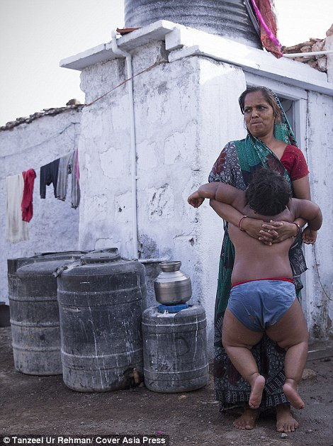 Vợ của Rameshbhai buồn bã cho biết cô không thể bế con, chỉ trông chừng chúng lăn khắp nhà, và phải dùng xe đẩy khi muốn đưa bọn trẻ đi ra ngoài. Lo ngại con mình sẽ mắc nhiều bệnh và có nguy cơ tử vong sớm, vợ chồng họ bàn bạc với nhau, anh Nandwana sẽ bán thận để lấy tiền đi tìm bác sỹ giỏi điều trị cho con mình.