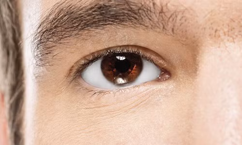 Dấu hiệu 5: Mắt đỏ ngầu. Điều này có nghĩa là bạn có thể bị cao huyết áp. Các mạch máu trong mắt bị hỏng chỉ ra rằng tình trạng cao huyết áp đã gây ra các mạch máu ở võng mạc xoắn lại, khiến chúng vỡ ra. Điều này có thể dẫn đến đột quỵ hoặc trụy tim.