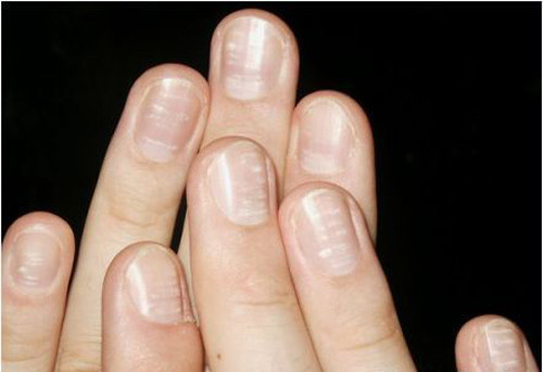 Dấu hiệu 6: Móng tay chuyển màu trắng đục. Móng tay hoàn toàn chuyển sang màu trắng đục chứng tỏ bạn đang gặp vấn đề với gan. Có thể do gan hoạt động kém, không có chức năng thải độc. Ngoài ra cũng nên cẩn trọng với bệnh tiểu đường, bệnh tim hoặc tuyến giáp hoạt động quá mức.