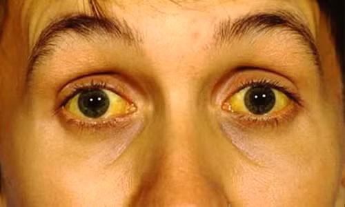 Tín hiệu 7: Da và mắt có màu vàng. Nếu dưới ánh sáng bình thường mà làn da và đôi mắt của bạn có màu vàng thì hãy đi khám sức khỏe bởi bạn đã bị viêm gan. Tiến sĩ Salma McIntyre, chuyên gia về nghiên cứu gan tại Foundation International, cho biết, bệnh vàng da là triệu chứng rõ ràng nhất của viêm gan. Nếu bạn thấy mình có những biểu hiện trên thì không nên coi nhẹ mà hãy tới gặp bác sĩ ngay lập tức.