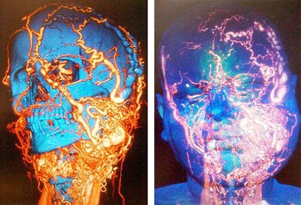 Tan muc ca phau thuat phuc tap nhat the gioi